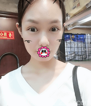 北京壹加壹雙眼皮修復(fù)+內(nèi)眥矯正+上瞼提肌矯正案例 北京壹加壹雙眼皮修復(fù)+內(nèi)眥矯正+上瞼提肌矯正案例