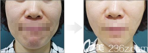 韓國lucea整形醫(yī)院面部提升手術(shù)案例