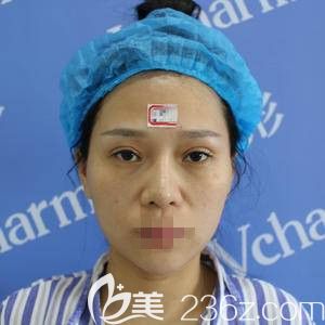 鄭州醫(yī)德佳做鼻整形失敗修復(fù)前 鄭州醫(yī)德佳做鼻整形失敗修復(fù)前