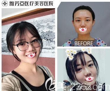 雅芳亞整形注射瘦臉案例 雅芳亞整形注射瘦臉案例
