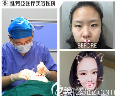 石家莊雅芳亞五月爆款整形項目大放價 雙眼皮和美容冠超值價為2880元