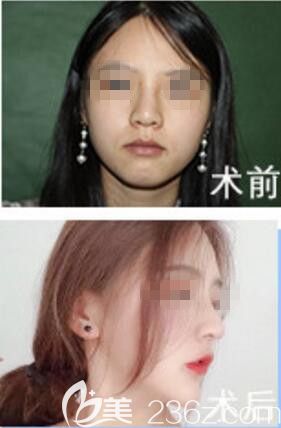 婁底希美整形鼻綜合整形真人前后效果對比圖