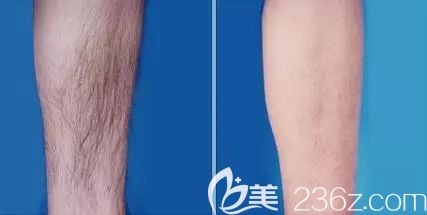 在南京維多利亞小腿脫毛前后對比照