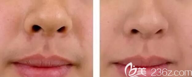 到南京維多利亞唇部脫毛前后對比照