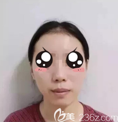 在東莞華美做脂肪填充術(shù)前照片 在東莞華美做脂肪填充術(shù)前照片