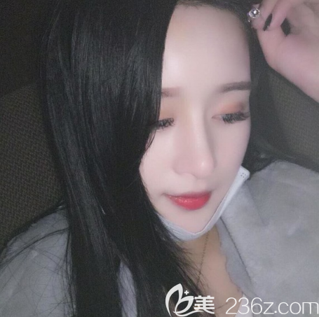 不得不說這次在東莞華美找詹慧院長做的自體脂肪面部填充不僅成活率高恢復(fù)也很快