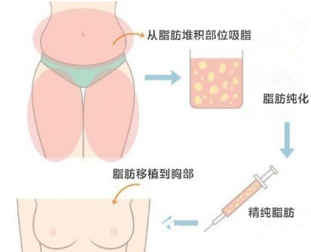 北京純脂自體脂肪豐胸手術(shù)過程示意圖