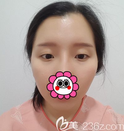 在韓國DI整形醫(yī)院做全臉脂肪填充+全切雙眼皮手術(shù)前 在韓國DI整形醫(yī)院做全臉脂肪填充+全切雙眼皮手術(shù)前