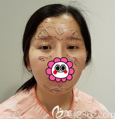 在韓國DI整形醫(yī)院做全臉脂肪填充+全切雙眼皮手術(shù)前設(shè)計(jì) 在韓國DI整形醫(yī)院做全臉脂肪填充+全切雙眼皮手術(shù)前設(shè)計(jì)