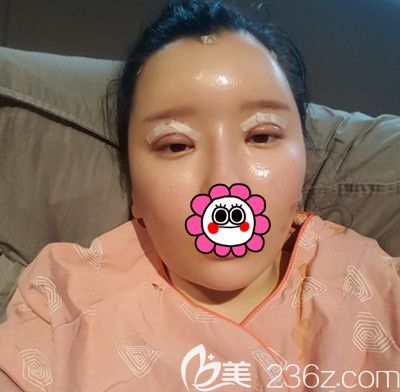 在韓國DI整形醫(yī)院做全臉脂肪填充+全切雙眼皮手術(shù)后1天 在韓國DI整形醫(yī)院做全臉脂肪填充+全切雙眼皮手術(shù)后1天