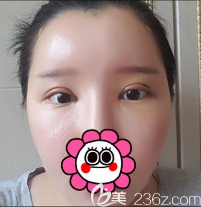 在韓國DI整形醫(yī)院做全臉脂肪填充+全切雙眼皮手術(shù)后7天 在韓國DI整形醫(yī)院做全臉脂肪填充+全切雙眼皮手術(shù)后7天
