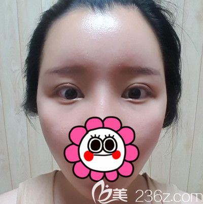 在韓國DI整形醫(yī)院做全臉脂肪填充+全切雙眼皮手術(shù)后2周 在韓國DI整形醫(yī)院做全臉脂肪填充+全切雙眼皮手術(shù)后2周