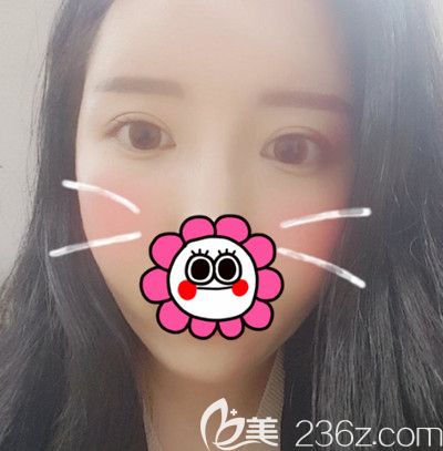 在韓國DI整形醫(yī)院做全臉脂肪填充+全切雙眼皮手術(shù)后1個(gè)月 在韓國DI整形醫(yī)院做全臉脂肪填充+全切雙眼皮手術(shù)后1個(gè)月