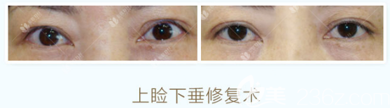 找曹仁昌做的眼睛修復(fù)案例對比圖 找曹仁昌做的眼睛修復(fù)案例對比圖