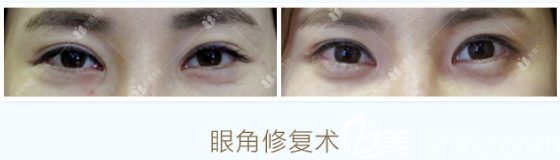 曹仁昌做的內(nèi)眼角修復(fù)案例對比圖 曹仁昌做的內(nèi)眼角修復(fù)案例對比圖