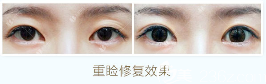 曹仁昌做的初眼重瞼修復(fù)案例 曹仁昌做的初眼重瞼修復(fù)案例