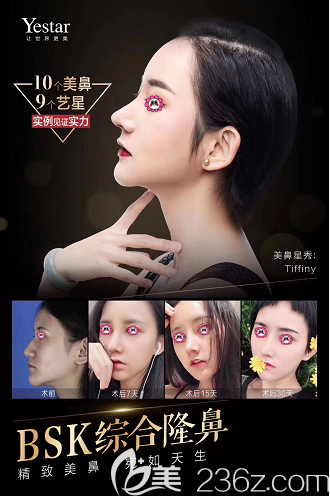 北京藝星BSK宮廷生態(tài)隆鼻案例