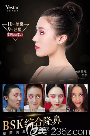 北京藝星BSK宮廷生態(tài)綜合隆鼻案例