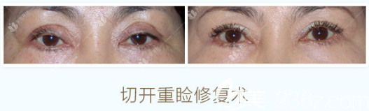 曹仁昌切開雙眼皮修復(fù)案例 曹仁昌切開雙眼皮修復(fù)案例