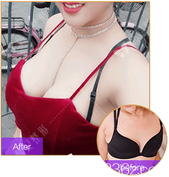 中山韓妃李光琴隆胸手術(shù)<span style= 中山韓妃李光琴隆胸手術(shù)<span style=