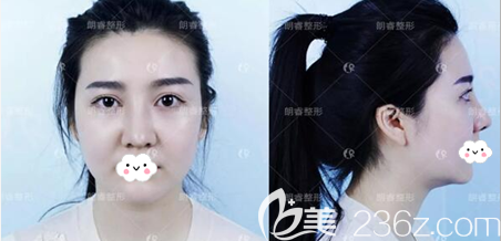 肋軟骨鼻綜合手術(shù)后正面?zhèn)让嬲掌? alt=