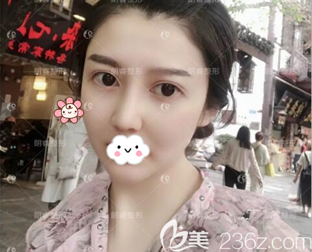 年后找盧剛做了肋軟骨鼻綜合手術(shù)改善短鼻，我成功摘掉豬豬鼻女孩稱號