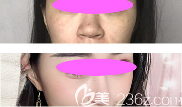 林麗德醫(yī)生做的全鼻整形案例效果對比圖 林麗德醫(yī)生做的全鼻整形案例效果對比圖