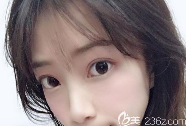  滿臉的雀斑被昆明夢想史小英激光祛斑一招搞定，一個月后也沒有反彈反黑的現(xiàn)象