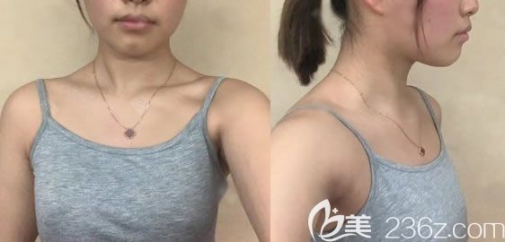 杭州薇琳整形做自體脂肪隆胸前 杭州薇琳整形做自體脂肪隆胸前