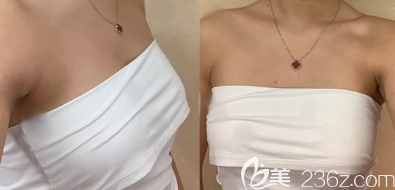 杭州薇琳自體脂肪隆胸<span style= 杭州薇琳自體脂肪隆胸<span style=