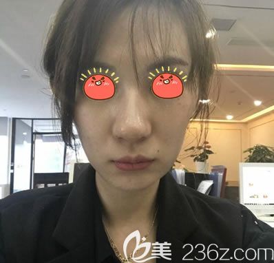 紹興藝美做自體脂肪全臉填充前 紹興藝美做自體脂肪全臉填充前