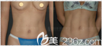 韓國純真整形醫(yī)院安敬天院長腰腹吸脂打造馬甲線案例