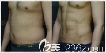 韓國安敬天院長5D吸脂雕塑打造腹肌案例