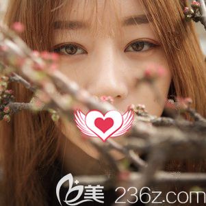 在唐山蘇亞美聯(lián)臣做4mm平行雙眼皮+開內(nèi)眼角兩個月了 都說我的恢復效果很自然