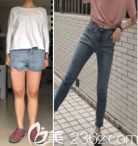 吸脂前后照片對(duì)比 吸脂前后照片對(duì)比