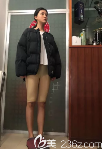 吸脂一個(gè)月的樣子 吸脂一個(gè)月的樣子