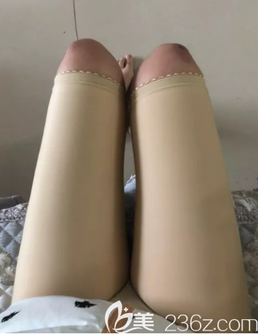 吸脂兩個(gè)月的樣子 吸脂兩個(gè)月的樣子