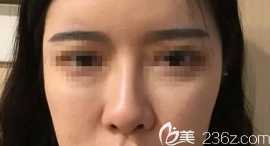 包頭葉子整形美容醫(yī)院綜合隆鼻前 包頭葉子整形美容醫(yī)院綜合隆鼻前
