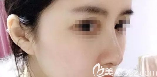 假體隆鼻半個(gè)月效果 假體隆鼻半個(gè)月效果