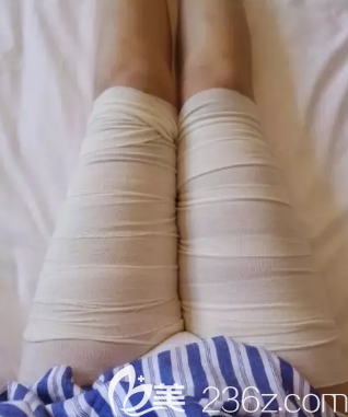 吸脂瘦大腿手術(shù)剛做完的時候