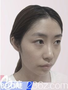 韓國然美之做全臉脂肪填充+鼻子微整形術前 韓國然美之做全臉脂肪填充+鼻子微整形術前