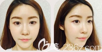 韓國然美之做全臉脂肪填充+鼻子微整形術后7天 韓國然美之做全臉脂肪填充+鼻子微整形術后7天