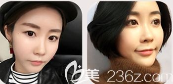 韓國然美之做全臉脂肪填充+鼻子微整形術后15天 韓國然美之做全臉脂肪填充+鼻子微整形術后15天