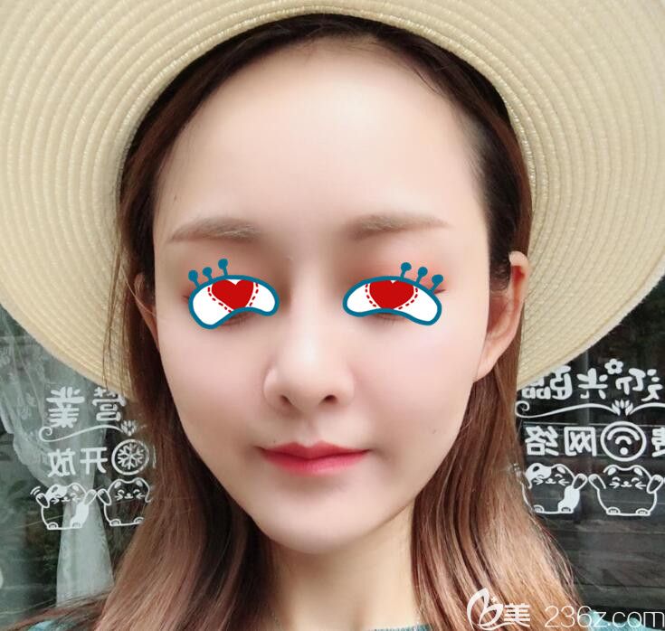 去合肥華美找楊鵬做自體脂肪填充全臉正好趕上活動價格很實惠 7個月我依舊美美噠