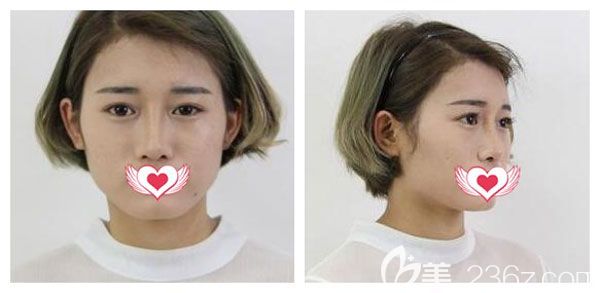 在昆明夢想割雙眼皮手術(shù)前 在昆明夢想割雙眼皮手術(shù)前