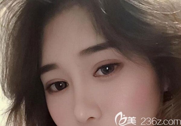 割雙眼皮兩個月沒有發(fā)現(xiàn)水腫 割雙眼皮兩個月沒有發(fā)現(xiàn)水腫