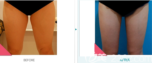 韓國(guó)DIONE吸脂皮膚門診大腿抽脂案例