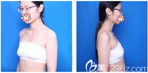 在深鵬程醫(yī)院做隆胸術前照片 在深鵬程醫(yī)院做隆胸術前照片