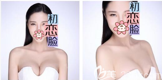 深圳鵬程醫(yī)院馬強做的隆胸手術<span style= 深圳鵬程醫(yī)院馬強做的隆胸手術<span style=