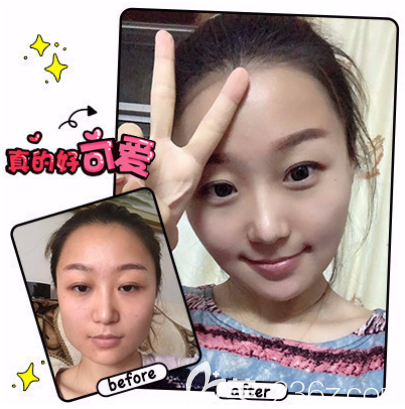 重慶愛(ài)思特下頜角整形